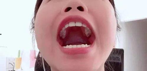 脱牙套网红,蜕变之路，笑对人生